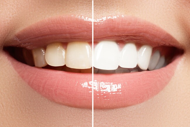ホワイトニング　白い歯　比較